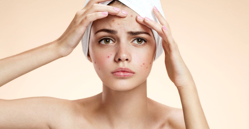 ACNE: wat is het en waarom heb ik het?