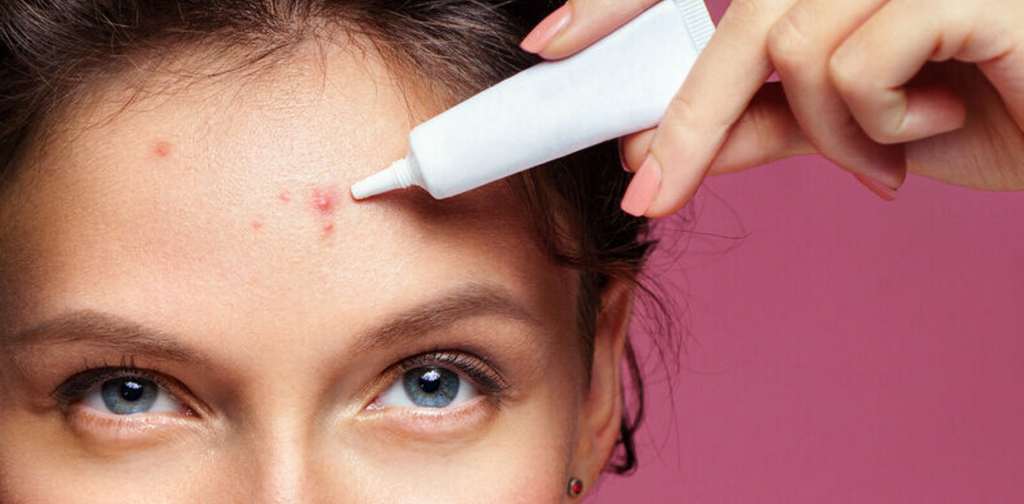 Acne bestrijd je zo!